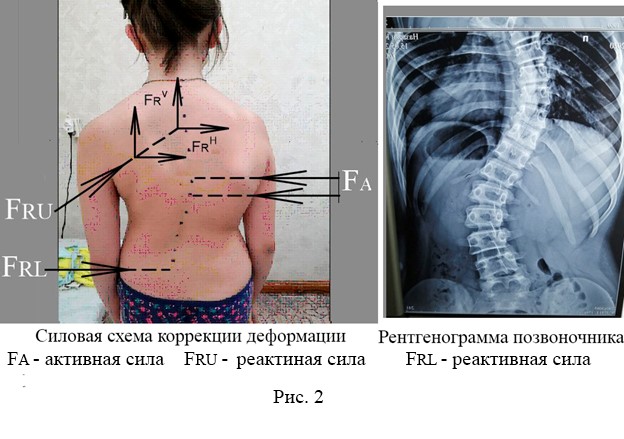 Секреты корригирующего корсета и корсетотерапии 2 рентгенограмма деформированного позвоночника